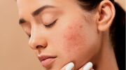 Gommage contre l’acné : comment soigner une peau acnéique ?