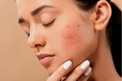 Gommage contre l’acné : comment soigner une peau acnéique ?