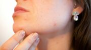 La luminothérapie contre l’acné
